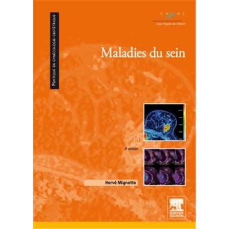 Maladies du sein