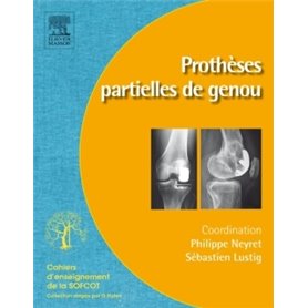 Prothèses partielles de genou