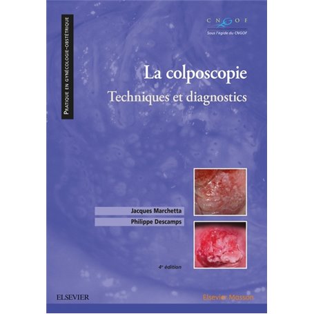 La colposcopie