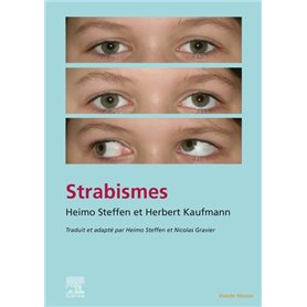 Strabisme