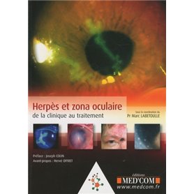 HERPES ET ZONA OCULAIRE