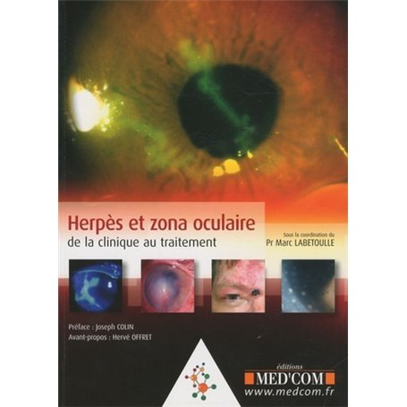 HERPES ET ZONA OCULAIRE