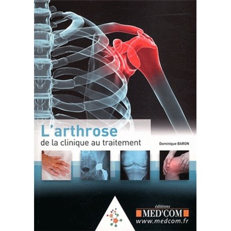 L'ARTHROSE : DE LA CLINIQUE AU TRAITEMENT