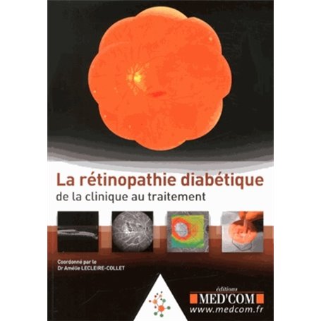 LA RETINOPATHIE DIABETIQUE :DE LA CLINIQUE AUTRAITEMENT