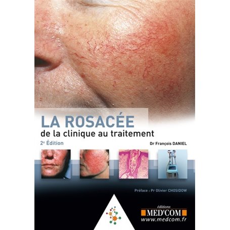 LA ROSACEE. DE LA CLINIQUE AU TRAITEMENT