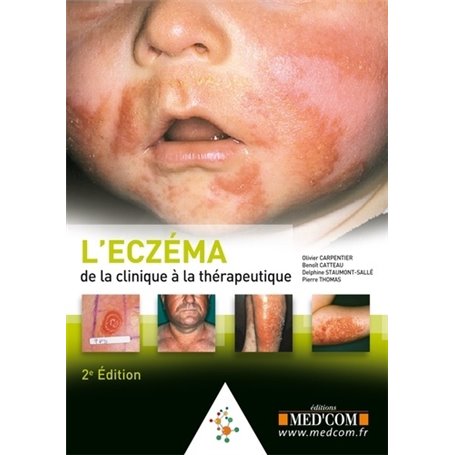 L ECZEMA. DE LA CLINIQUE AU TRAITEMENT. 2  ED