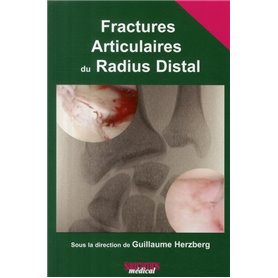 FRACTURES ARTICULAIRES DU RADIUS DISTAL