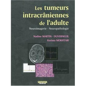 LES TUMEURS INTRACRANIENNES DE L ADULTE