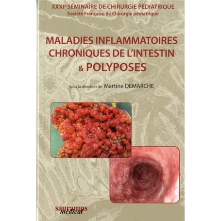 MALADIES INFLAMMATOIRES CHRONIQUES DE L'INTESTIN & POLYPOSES