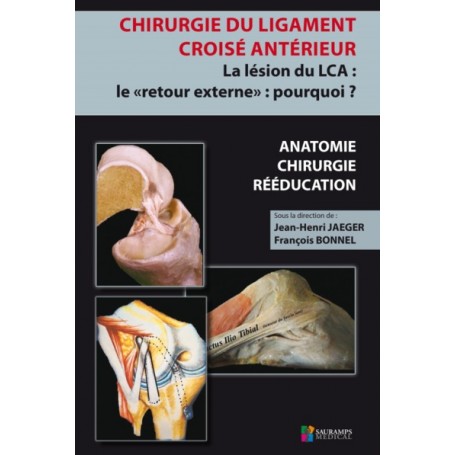 CHIRURGIE DU LIGAMENT CROISE ANTERIEUR. LA LESION DU LCA...