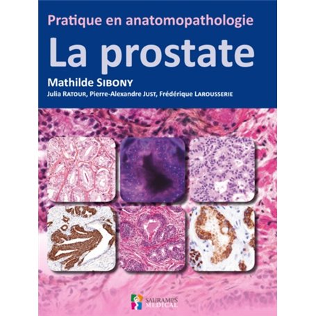 PRATIQUE EN ANATOMOPATHOLOGIE - LA PROSTATE