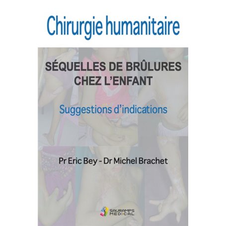 CHIRURGIE HUMANITAIRE. SEQUELLES DE BRULURES CHEZ L ENFANT