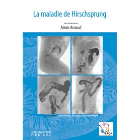 La maladie de Hirschsprung