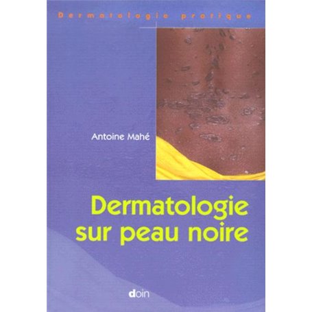 Dermatologie sur peau noire