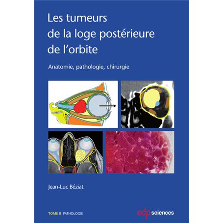 Les tumeurs de la loge postérieure de l'orbite - Tome 2