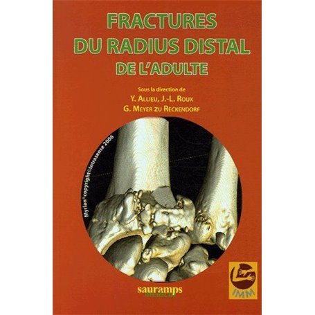 FRACTURES DU RADIUS DISTAL DE L ADULTE