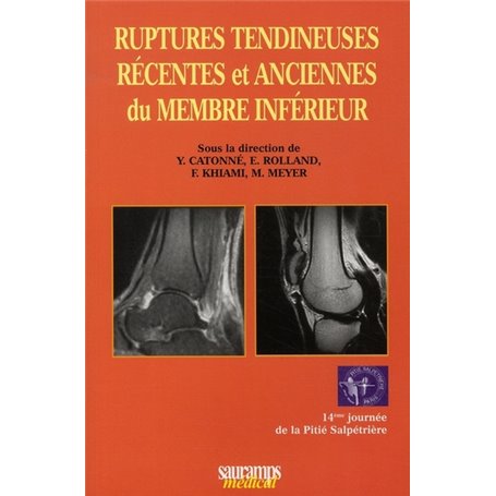 RUPTURES TENDINEUSES RECENTES ET ANCIENNES DU MEMBRE SUPERIEUR