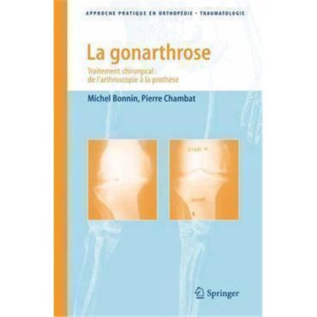 La gonarthrose