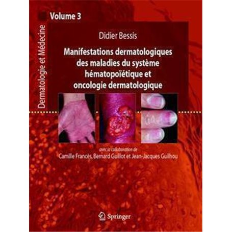 Manifestations dermatologiques des maladies du système hématopoïétique et oncologie dermatologique