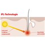 Épilateur à lumière pulsée IPL-130 avec lunettes de protection et écran LCD [Sichler Beauty]