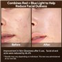 Appareil Radiofréquence Lifting Visage, Ibtyzo Appareil Visage Lifting EMS Appareil Anti Rides Visage 6 en 1 RF Masseur Visage R