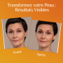 Vitamine C Sérum Visage pour Microneedling + Acide Hyaluronique & Vitamine E | Soin Visage et Contour des Yeux | Anti Cerne, Ant