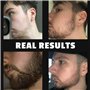 Rouleau pour la pousse de la barbe Red-Blooded | 540 aiguilles en titane de 0,5 Mm | Rouleau Derma pour hommes | Rouleau barbe n