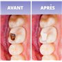 Plomabdent-Pansement dentaire pour boucher une carie, obturation d'un trou, un plombage ou amalgame perdus. Fabrication 100% fra