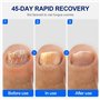 Mycose Ongles Pied Appareil Traitement avec Minuterie et Lumière rouge & bleue & laser froid pour Traitement Champignons Ongles 