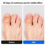 Mycose Ongles Pied Appareil Traitement avec Minuterie et Lumière rouge & bleue & laser froid pour Traitement Champignons Ongles 