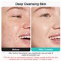 Aspirateur Point Noir Visage, Lrbsule Tire Comedon Point Noir Extracteur Nettoyant de Pores Blackhead Remover Aspirateur Point B