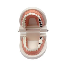 Youya - Modèle de dents de caries dentaires standard - Outil d'étude pour les maladies des adultes - Modèle standard - Pour appr