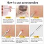 10Pcs Extracteur Point Noirs Professional Trousse à Outils, Blackhead Remover Outil avec Boîte Extracteur de Point Noir pour Tir