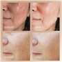 Reinvo Baguette de microdermabrasion faciale par Project E Beauty
