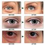 Hydrogel Eye Patch