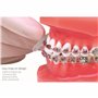 remplace la Cire Orthodontique | prévient Plaies Écorchures sur les Gencives | Réutilisabl