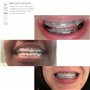 Protège-Lèvres pour Bagues dentaires, remplace la Cire Orthodontique | prévient Plaies Écorchures sur les Gencives | Réutilisabl