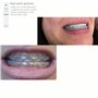 Protège-Lèvres pour Bagues dentaires, remplace la Cire Orthodontique | prévient Plaies Écorchures sur les Gencives | Réutilisabl