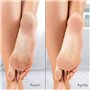 Râpe électrique anti-callosités Silk'n Vacupedi avec aspiration intégrée et 2 râpes incluses