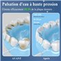 Détartreur Hydropulseurs Et Irrigateurs Nettoyage Dents