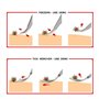 JIEYUCHU Pince à Tiques, 2 en 1 Pince à Tiques en Acier Inoxydable, Professionnel Crochets à Tiques en Métal avec étui, pour Les