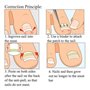 Young21 Clip De Redressement D'Ongle Incarné Outil De Correction De Paronychie Épaisse BS Brace Toenails