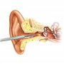 MJW Professionnel Dissolvant de Cérumen D'acier Inoxydable Curette Auriculaire Hygiénique Nettoyage pour Enlever Irrigation des 