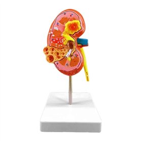 Modèle d'anatomie 4D Modèle d'anatomie du Rein Humain Modèle d'enseignement Organes Humains Modèle de Rein Malade Modèle de Corp