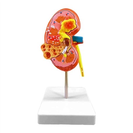 Modèle d'anatomie 4D Modèle d'anatomie du Rein Humain Modèle d'enseignement Organes Humains Modèle de Rein Malade Modèle de Corp