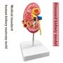 Modèle d'anatomie 4D Modèle d'anatomie du Rein Humain Modèle d'enseignement Organes Humains Modèle de Rein Malade Modèle de Corp