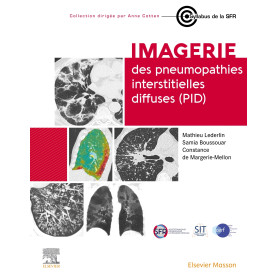 Imagerie des pneumopathies interstitielles diffuses (PID)