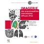 Imagerie des pneumopathies interstitielles diffuses (PID)