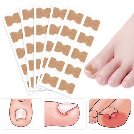 Lot de 50 patchs de correction des ongles incarnés sans colle pour ongles d'orteils pour soins des pieds