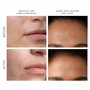 FOREO KIWI derma Appareil dermabrasion visage Extracteur point noir - Skincare - Aspirateur point noir - Extraction sans bandele